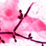 A Candid Look at Candida Albicans aka Vaginal Yeast Infection