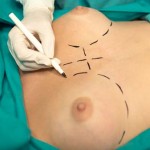 breast surgery