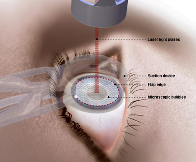 lasik-eye-surgery