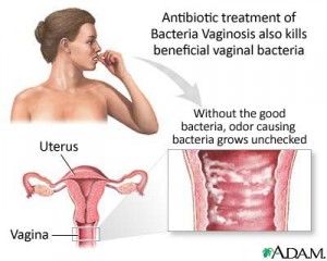 bacterial vaginosis