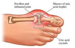 gout remedies